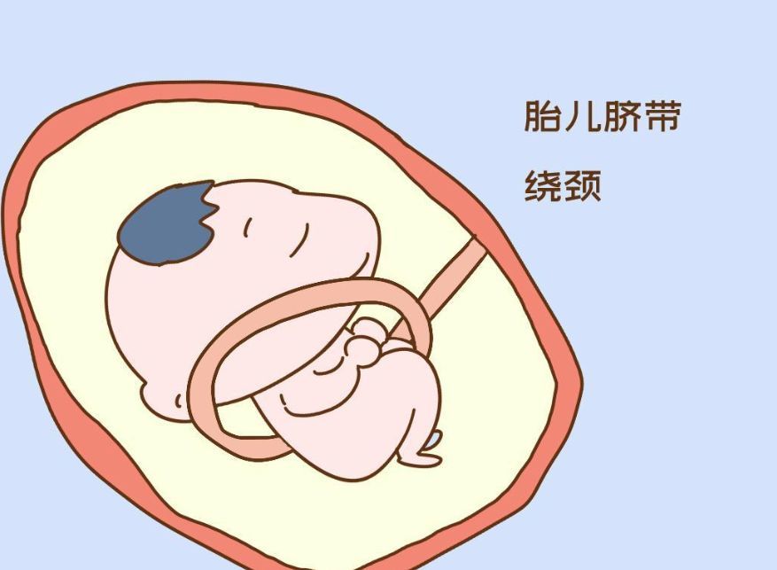 脐带绕颈和睡姿有关吗，孕妇睡姿会导致脐带绕颈吗