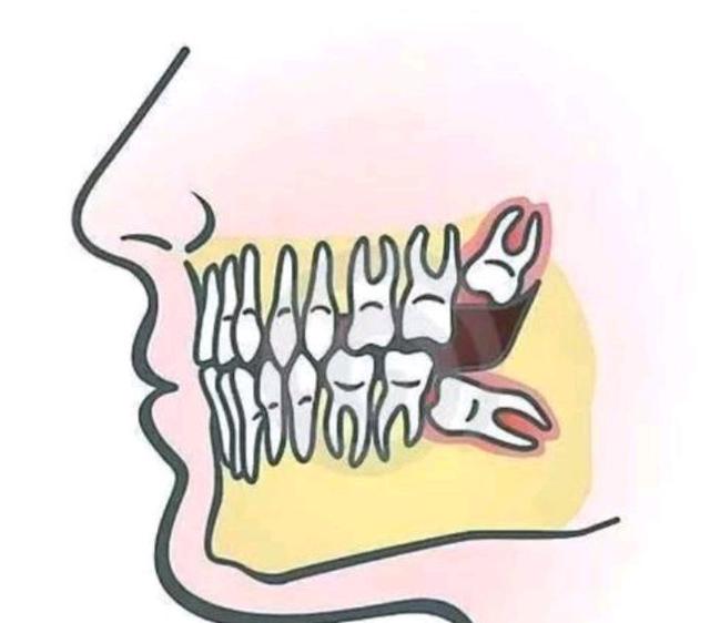 智齿是长在哪个位置，智齿的位置图片 