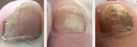 不严重的灰指甲图片怎么治疗5