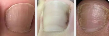 不严重的灰指甲图片怎么治疗3